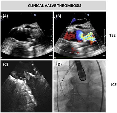 Clinical Valve Thrombosis and Subclinical Leaflet Thrombosis Following Transcatheter Aortic Valve Replacement: Is There a Need for a Patient-Tailored Antithrombotic Therapy?